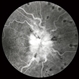 FA Late Phase Optic Disc Edema FA Late Phase Optic Disc Edema